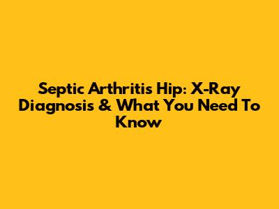 Septic Arthritis Hip: X-Ray Diagnosis & What You Need To Know